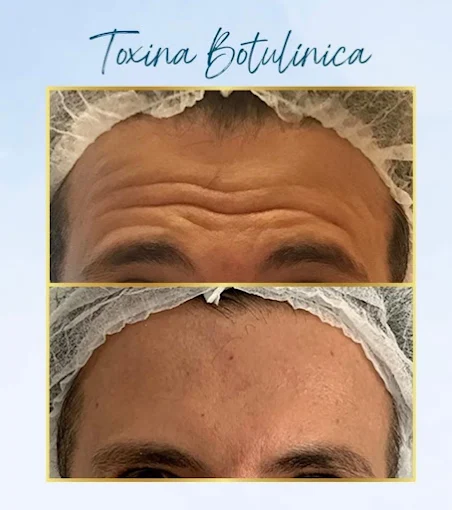 Caso clínico de Botox e preenchimento facial na Clínica Biavatti
