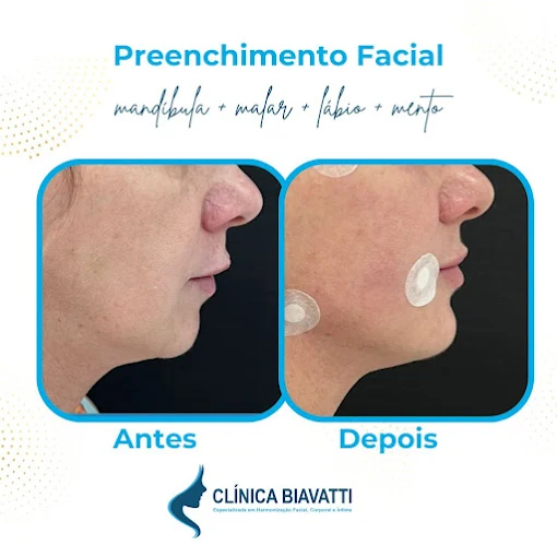 Antes e depois de preenchimento facial na Clínica Biavatti Maringá