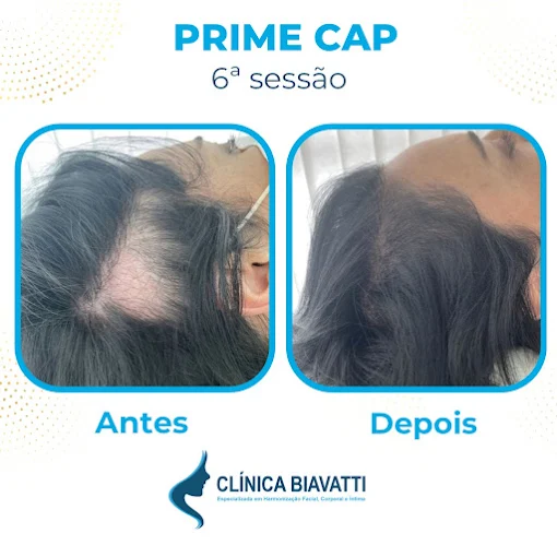 Resultado de harmonização facial com técnica refinada na Clínica Biavatti