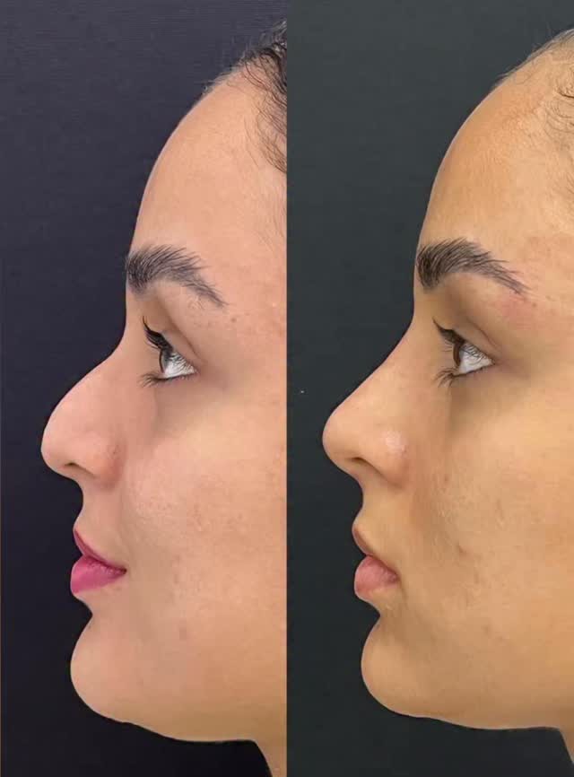Caso real de Botox e preenchimento na Clínica Biavatti, Maringá