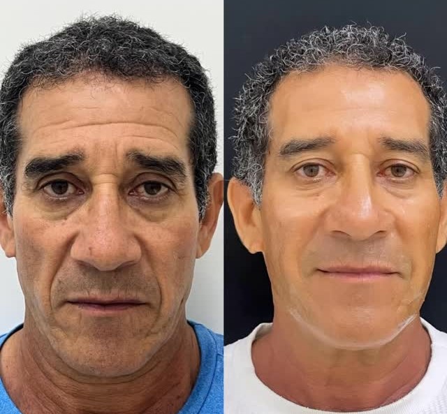 Antes e depois de paciente da Clínica Biavatti em Maringá